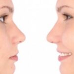 l’acné Trouble cutané caractérisé par des points noirs récurrents, des points blancs et des boutons qui peuvent se trouver sur le visage, le dos, la poitrine, les épaules ou Bras
